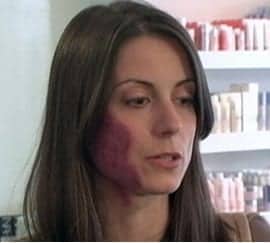 birthmark in an unwanted place