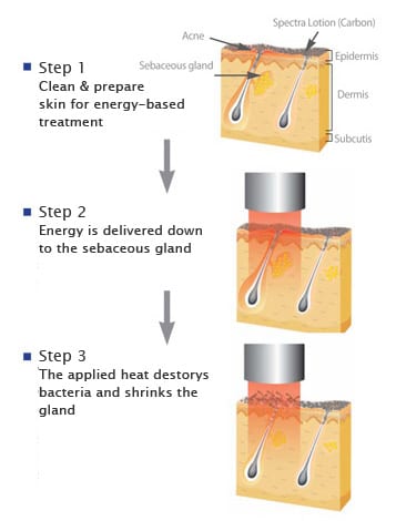 How Spectra laser treatment clears up active acne: Spectra levels out acne bumps by targeting sebaceous glands.*