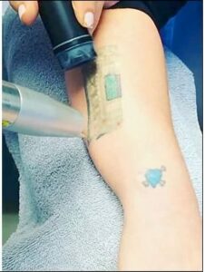 When tattoo removal gained popularity through celebrity endorsement, it inspired many people to ask "How much is tattoo removal?"