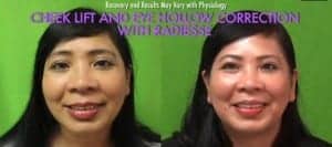 Radiesse is one of the best filler injections in cheeks 