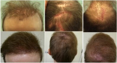 Before finding repair and hope from Dr U in Los Angles California who used Dr.UGraft hair transplant repair to fix him, this California patient began is hair restoration journey with a hair transplant tourism journey with a clinic in Canada