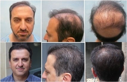 Severe hair loss treatment using Dr.UGraft