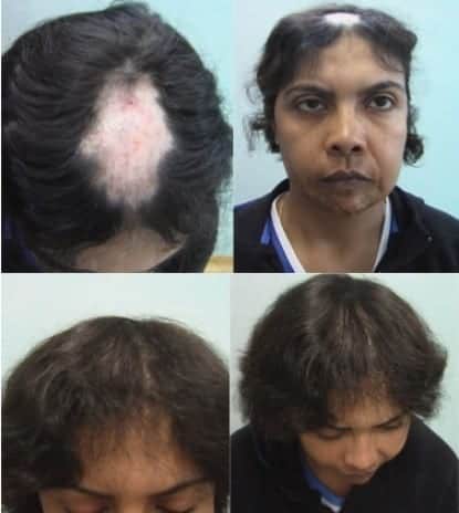 Female baldness can results from a number of conditions, including genetics, hormones, or damage to hair follicles
