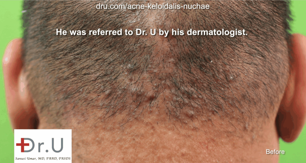 An example of how Acne Keloidalis Nuchae or AKN can manifest on an individual's scalp.* An example of how Acne Keloidalis Nuchae or AKN can manifest on an individual's scalp.*