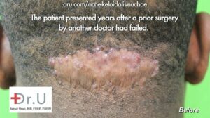 Acne keloidalis nuchae can coalesce into a single lesion.