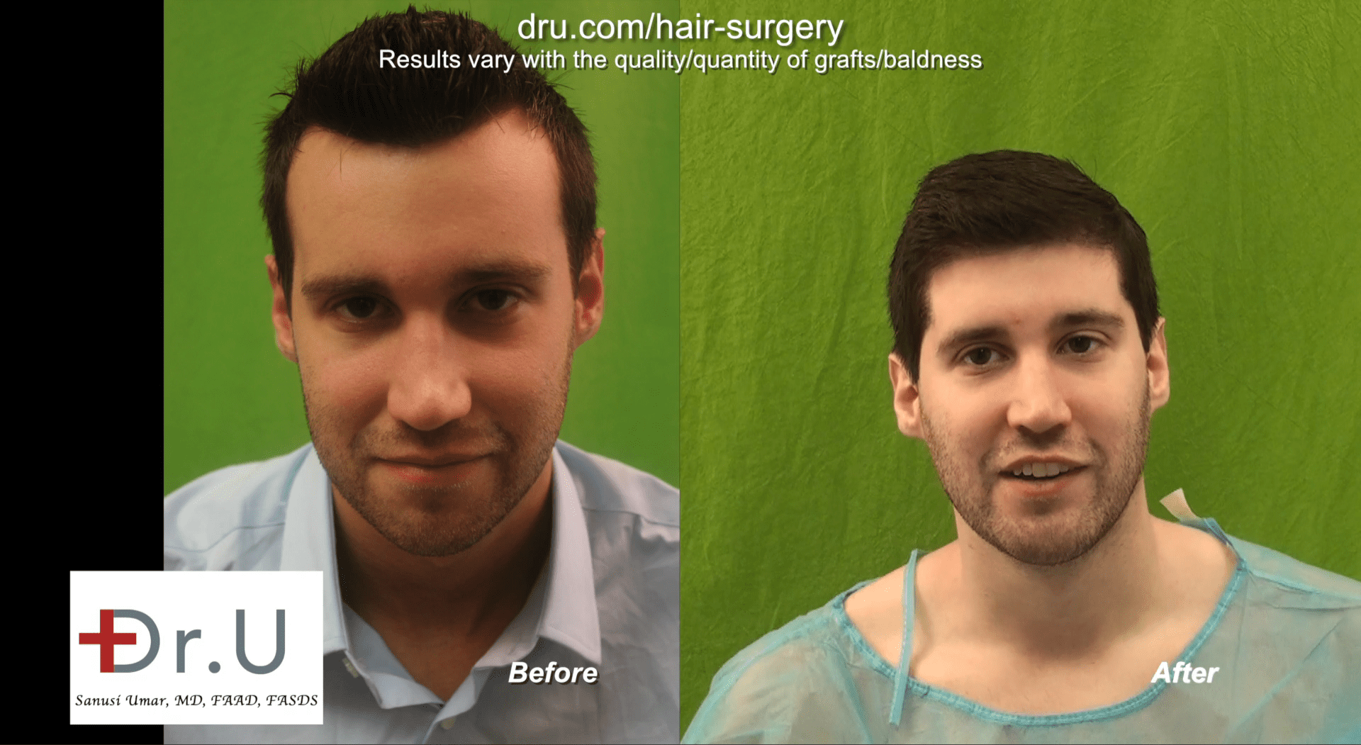 Before and After - Hairline Reduction Surgery using Dr.UGraft Method. Before and After - Hairline Reduction Surgery using Dr.UGraft Method.