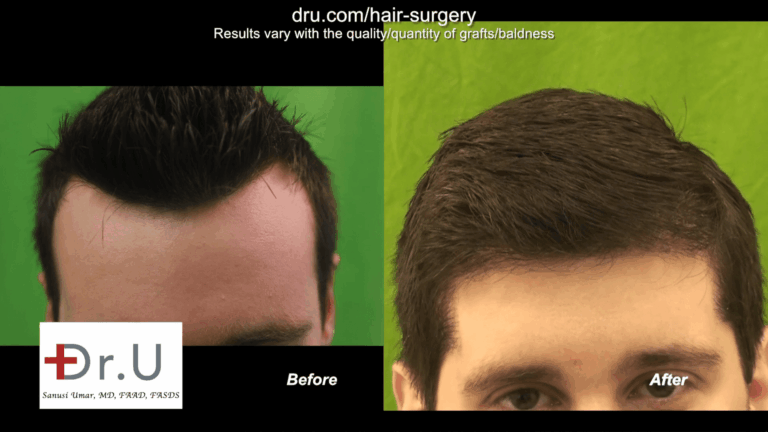 This lowered hairline from Dr. U's advanced DrUGraft FUE system had excellent results.