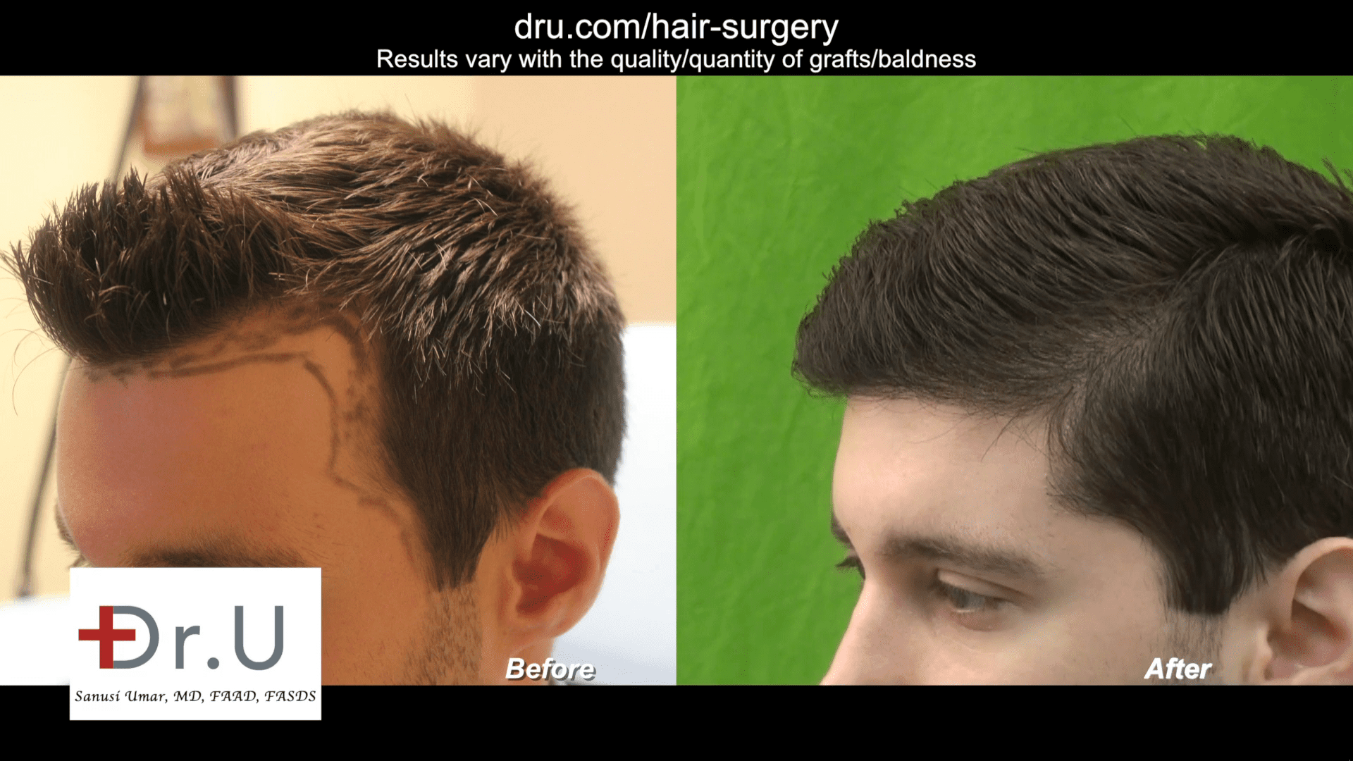 Forehead Reduction Before and After with Advanced FUE Hair Repair Surgery Forehead Reduction Before and After with Advanced FUE Hair Repair Surgery