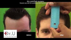 Dr. U showing the forehead size difference from his patient who underwent a hairline lowering FUE.