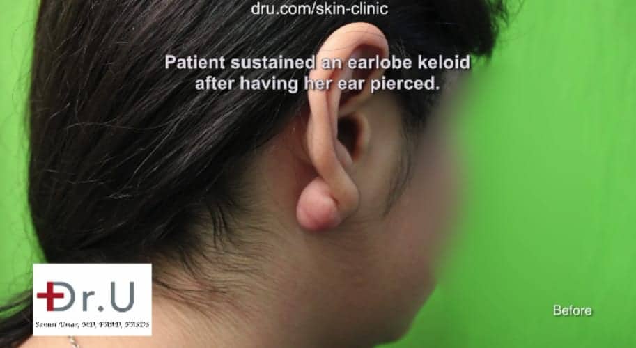 A patient's keloid before Dr U flap excision surgery to repair earlobe keloid