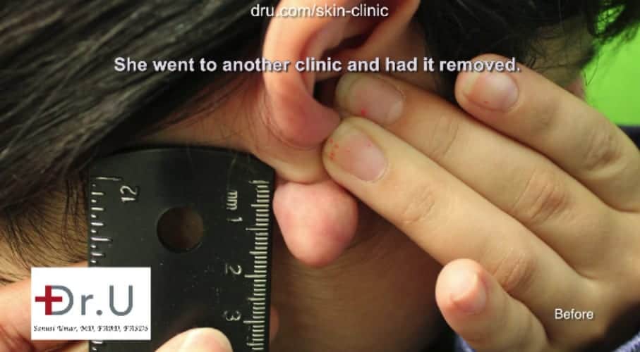 Keloid after ear piercing and before Dr U flap excision surgery to repair earlobe keloid