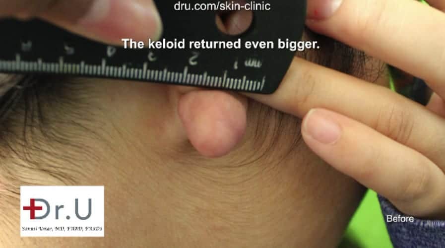 Dr U flap excision surgery to repair earlobe keloid was necessary to correct excessive development of damaged tissue