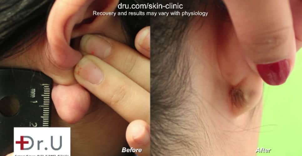 Before and after keloid removal - The Dr U flap excision surgery* 