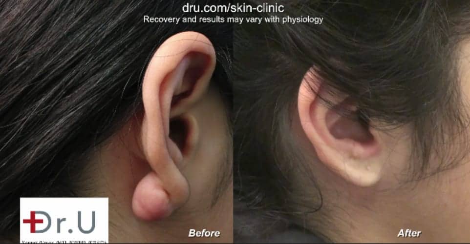 Dr U flap excision surgery to repair earlobe keloid is an effective remedy*