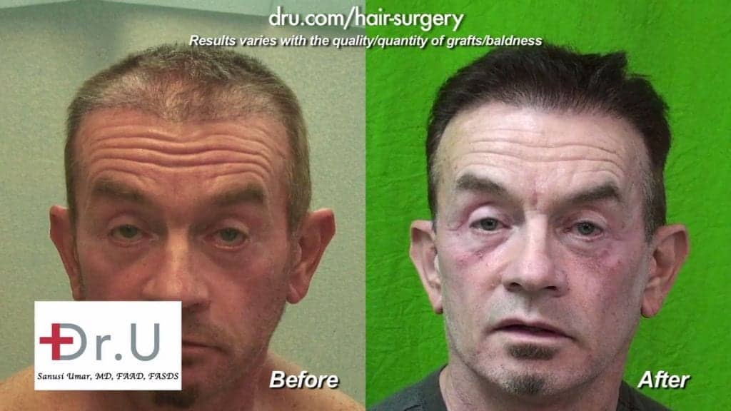 2850 FUE Dr.UGrafts restored this patient's hair