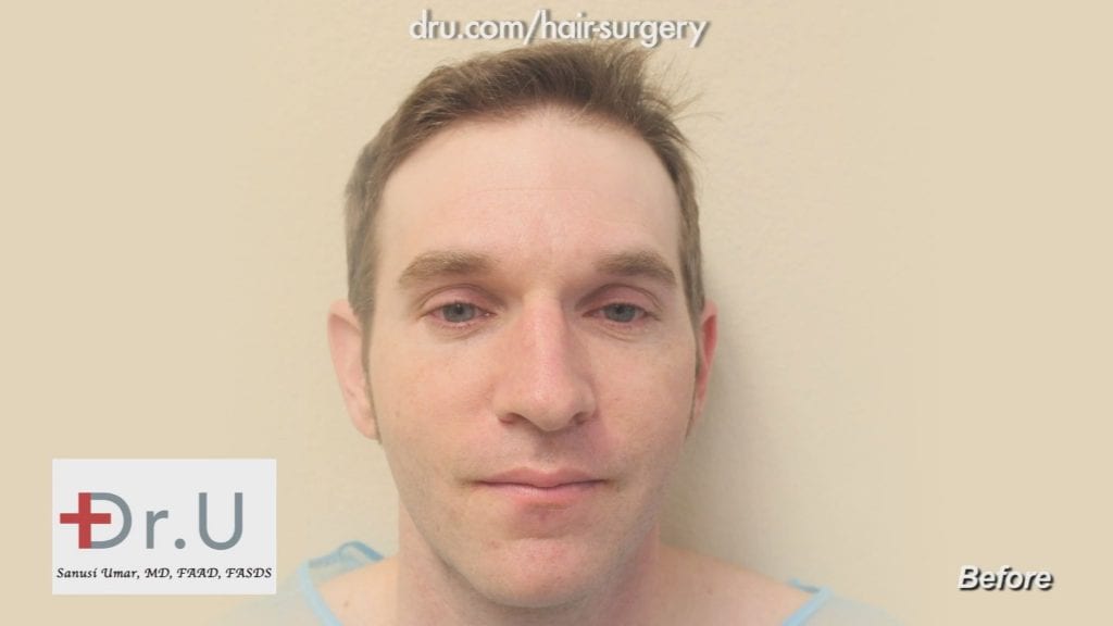 Receding hairline and crown - Before Dr.UGraft Restoration