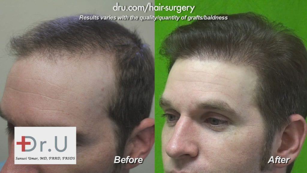 Before and After Advanced FUE with Dr.UGraft: Receding hairline and crown restored