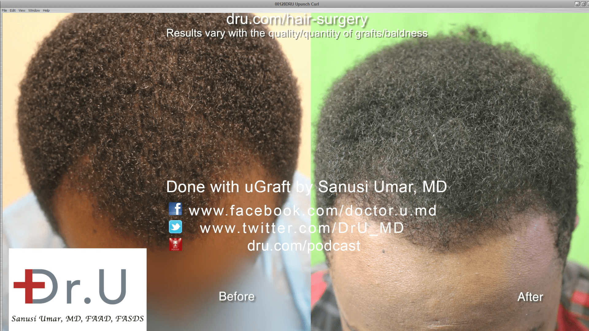 Black male hair transplant before and after.