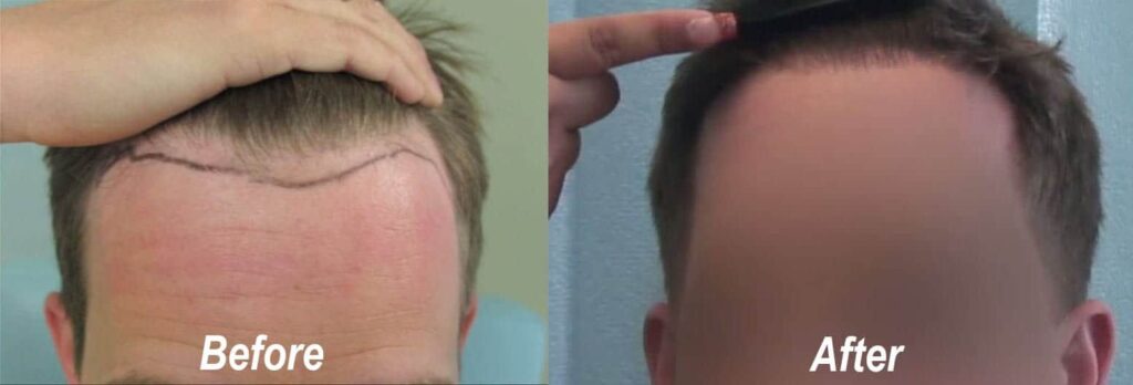 The hairline on this patient of Dr. U was lowered only a little, but made a significant difference.*