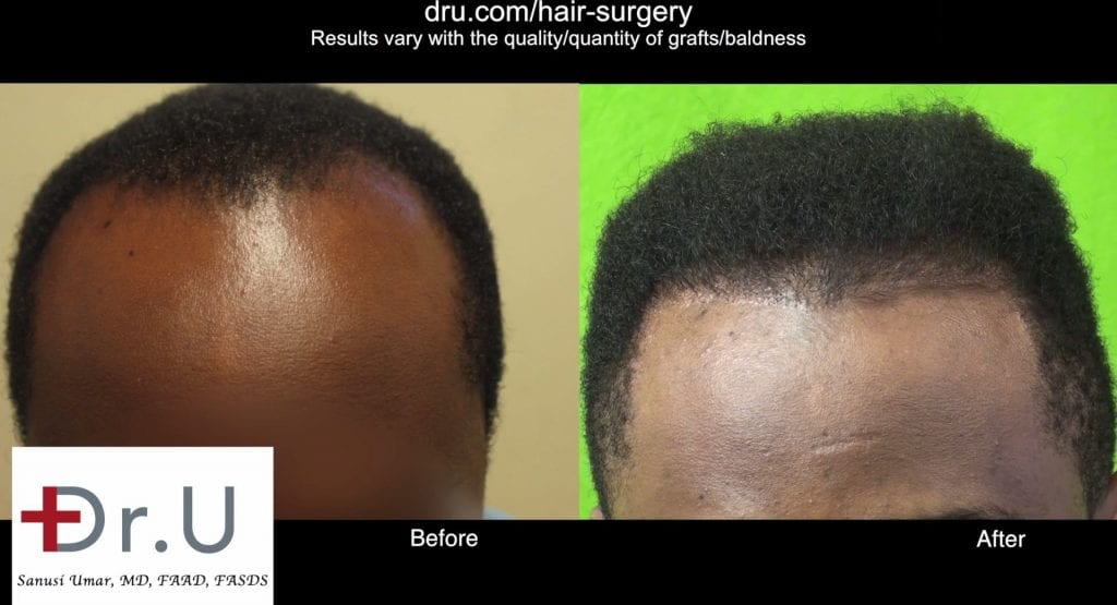 Black male hair transplant Cost (FUE vs Strip): The patient opted for treatment with the Dr.UGraft for best Linear Scar Free Black Hair Restoration