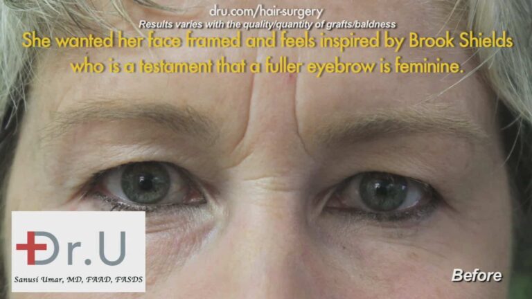 Before Eyebrow Hair Loss Treatment: Loss of hair before Dr.UGraft 