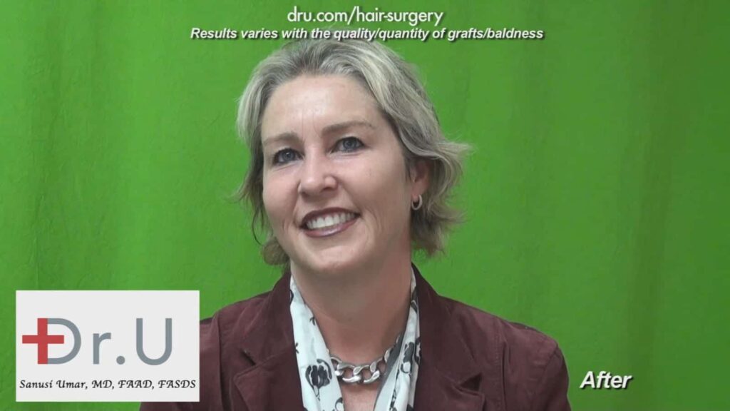 Dr UGraft Surgery For Eyebrow Hair Loss Treatment Achieves Brook Shields Eyebrow Look