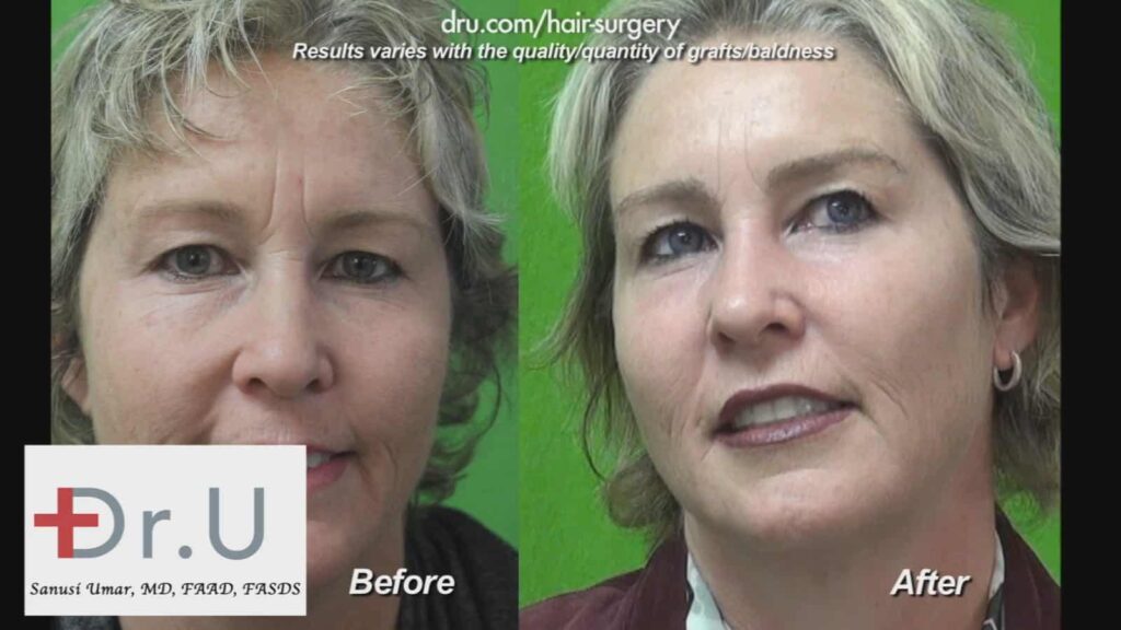 Understanding Hair Transplant Surgery Through Research