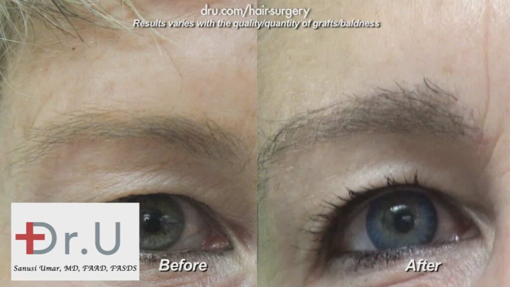 Understanding Hair Transplant Surgery Through Research