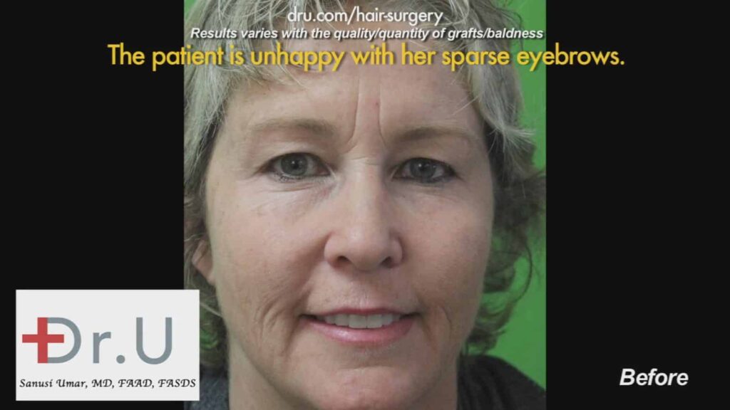 Understanding Hair Transplant Surgery Through Research