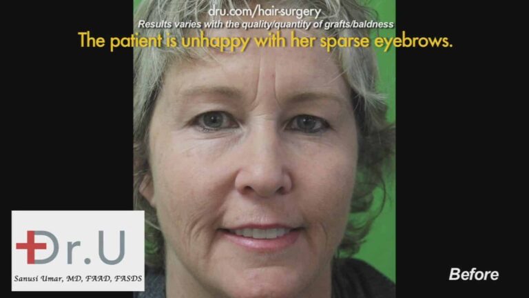 Before Dr.UGraft Eyebrow Hair Loss Treatment