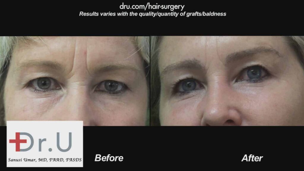 Before and After DrUGraft FUE repair with body hair transplant using 9000 Dr.UGrafts 