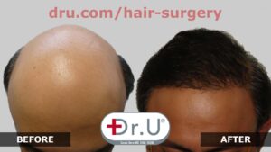 After being labeled a lost cause, this patient receives a full NW 7 Hair Restoration in Los Angeles with Dr. Umar using his Dr.UGraft.