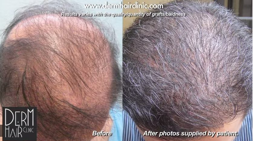 A patient with prior hair transplant procedures turned to the best FUE hair transplant clinic in the world for repair