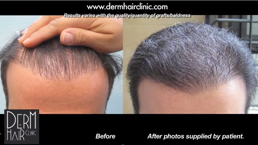 Every angle of a patient's hair restoration can look natural once again with the DrUGraft method and the best hair restoration clinic in the world