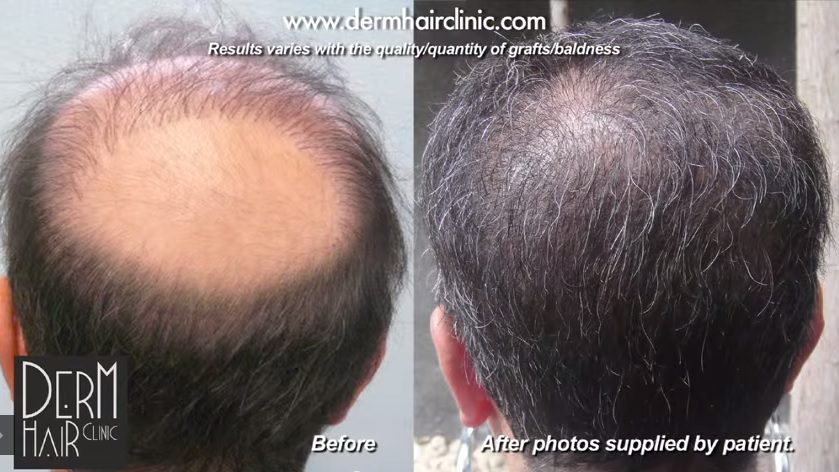 A successful hair restoration, and the best hair restoration clinic in the world, can repair severe baldness or the effects of previous procedures
