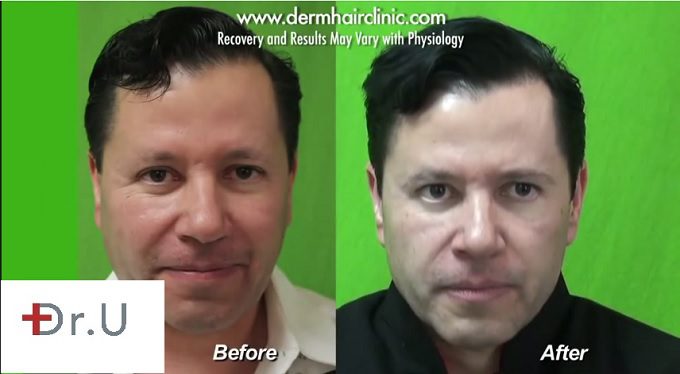 This patient's hairline is fuller after the DrUGraft procedure at the best hair restoration clinic in the world