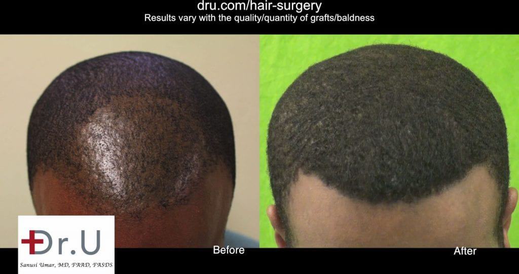 black male hair transplant cost: You save in cost by having it done properly the first time. Results after the Dr.UPunch Curl tool repaired poor FUE outcome from another clinic transplant.