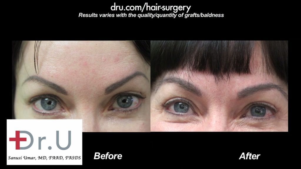Eyebrow Hair Transplant Covers Eyebrow Tattoo Using Dr UGraft In Los Angeles Patient Before and After Photos