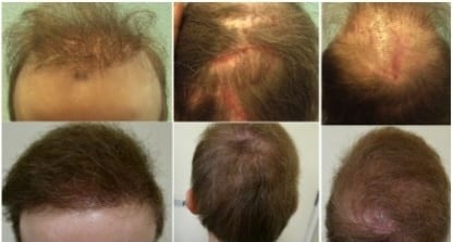 Patient's prior procedure required the best hair transplant repair doctor in the world