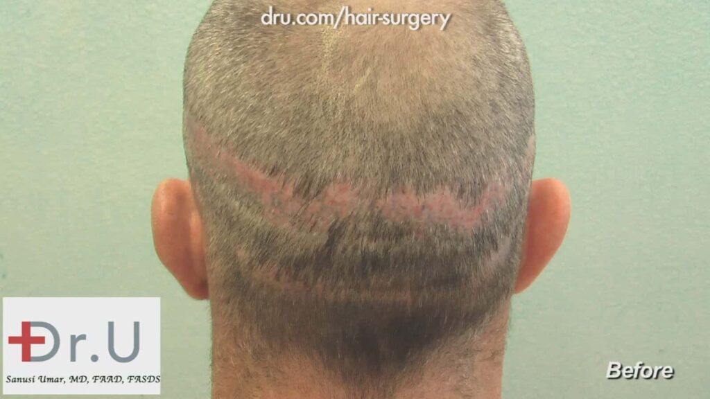 Before Hair Transplant Scar Revision: visible scarring