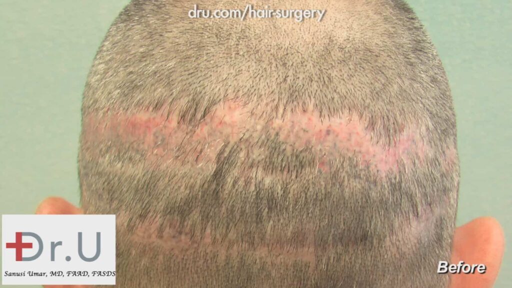 Even trichopigmentation did not conceal this patient's extensive scarring.