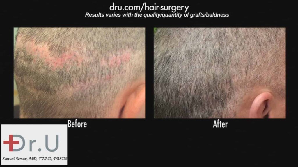 Strip scar repair using only beard hair grafts: A close-up of Dr. U's results when covering this patient's scars.* Strip scar repair using only beard hair grafts: A close-up of Dr. U's results when covering this patient's scars.*