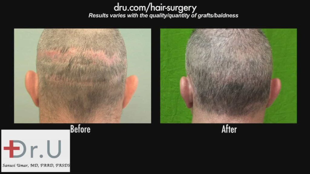 Before and after photos of a patient of Dr. Uma who had significant scarring on the back of his head.