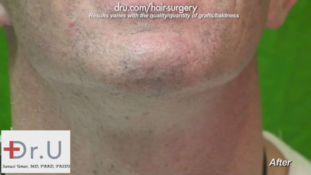 FUE hair transplant from beard: The Dr.UGraft procedure left the patient with little to no trace of scar tissue or wounds.