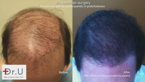 Dr UGraft BHT FUE Hair Repair Using 8000 Grafts on Norwood 6 Patient