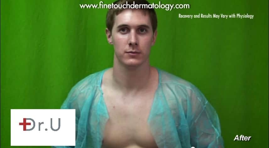 After his treatment with Dr. U in Los Angeles this patient no longer had the red bumped that covered his chest.* What can I do for rosacea? V Beam laser is the best treatment for rosacea.