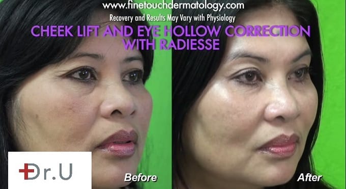 Non surgical cheek augmentation with fillers lift restores midface volume