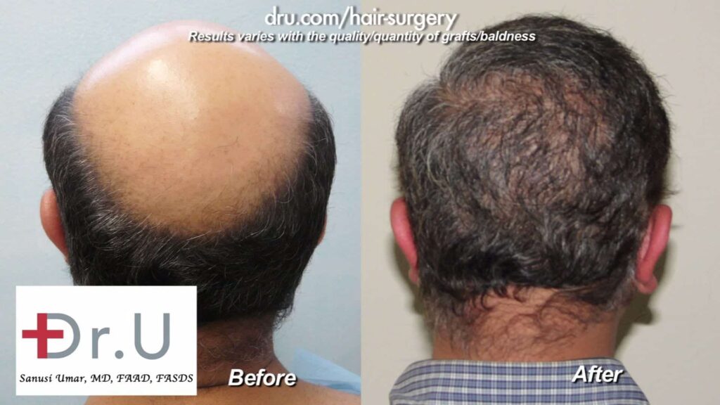 Beard transplant before and after: Patient who suffered from severe hair loss received FUE beard and body hair transplantation from Dr. Umar's advanced Dr.UGraft BHT method.* Beard transplant before and after: Patient who suffered from severe hair loss received FUE beard and body hair transplantation from Dr. Umar's advanced Dr.UGraft BHT method.*