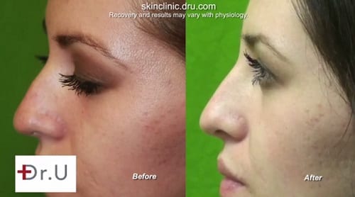 Nose enhancement without surgery before and after