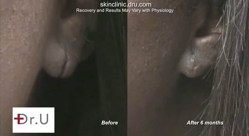 Torn ear corrected through ear split repair in Los Angeles.